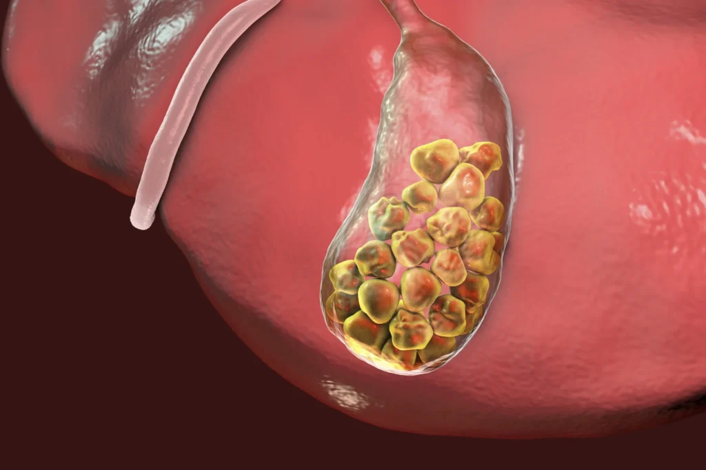 Gallbladder Stones