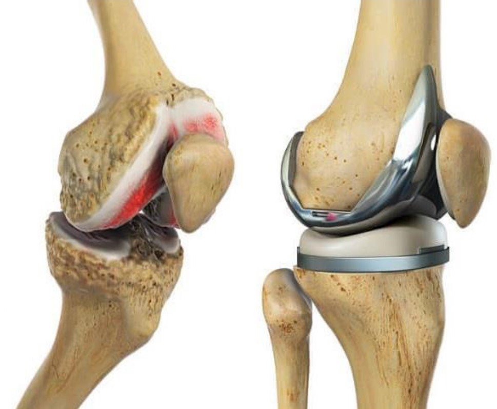 Knee Replacement