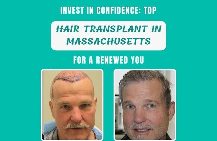 Invest-in-Confidence-Top-Hair-Transplant-in-Massachusetts-for-a-Renewed-You