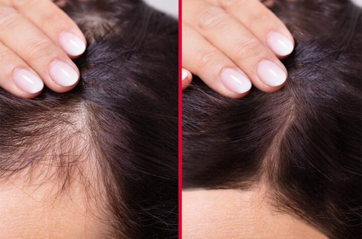 HAIR XCELLERATION PROGRAM