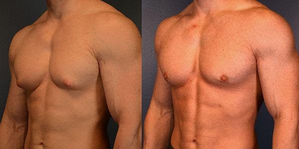 gynecomastia surgery in dubai