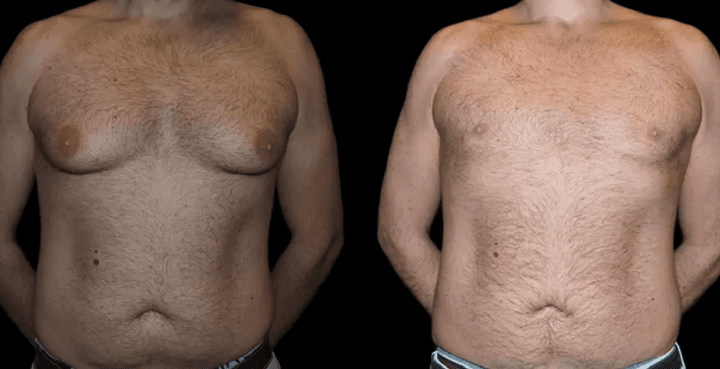 male breast reduction with before and after results