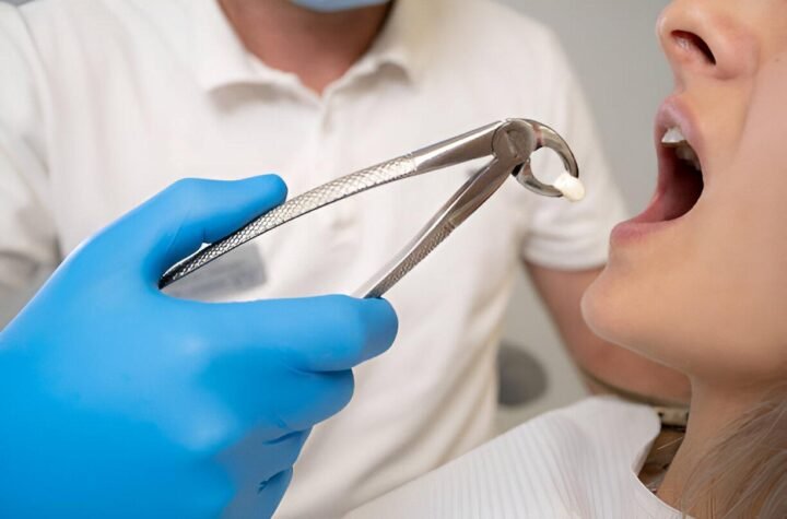 Tooth Extractions