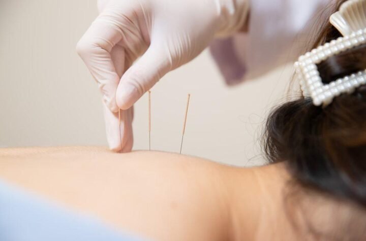 Acupuncture Treatment