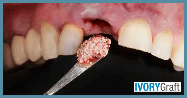 Dental Bone Graft: What It Is and Why It’s Important for Oral Health