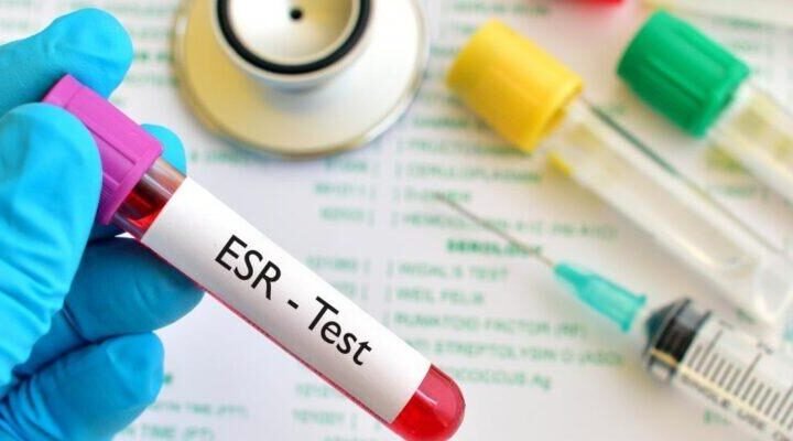 ESR Test